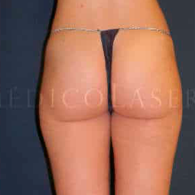 Liposucci N L Ser En Cartucheras En Iml Madrid Antes Y Despu S Iml